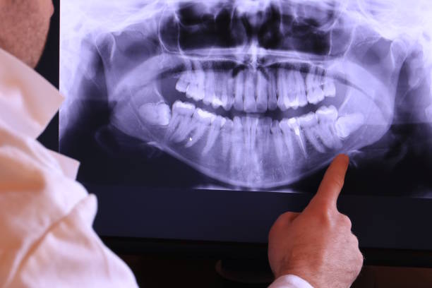Best Emergency Dental Extractions in Mocksville, NC
